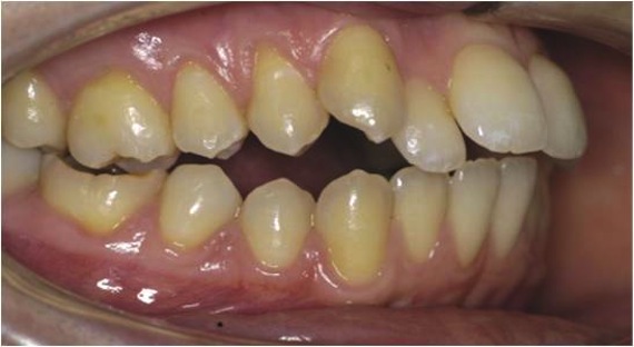 Ortodonzia negli adulti prima del trattamento