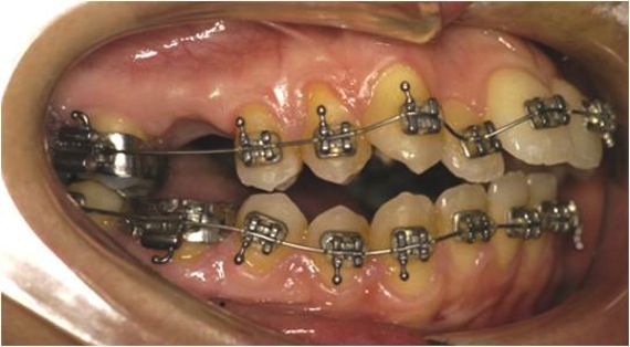 Ortodonzia negli adulti durante una fase della terapia