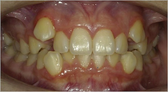 Condizione iniziale: affollamento dentale grave