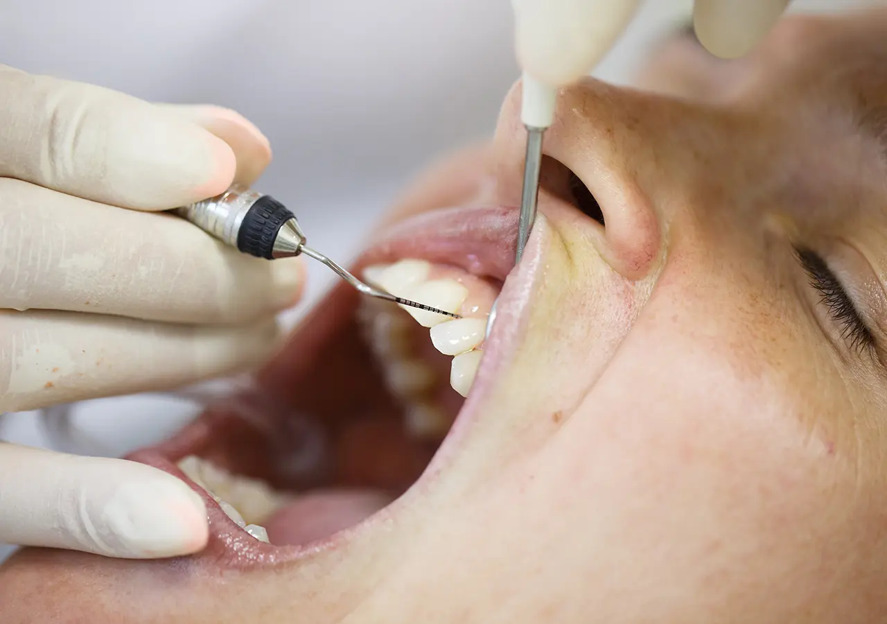 Parodontologia - Studio Dentistico Poggio - Dentista a Milano, Duomo