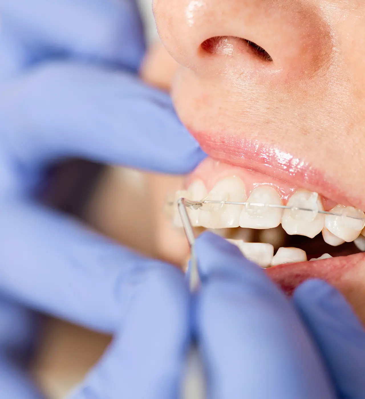 Apparecchi dentali - Studio Dentistico Poggio - Dentista a Milano, Duomo