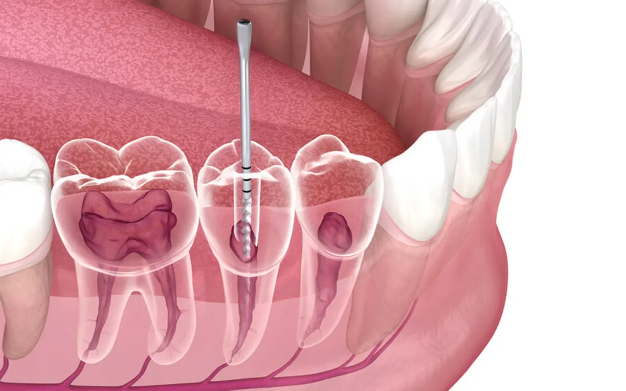La terapia endodontica per salvare i denti - Studio Dentistico Poggio - Dentista a Milano, Duomo