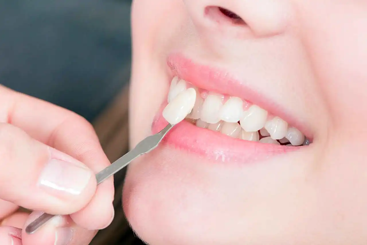 Le faccette dentali in ceramica - Studio Dentistico Poggio - Dentista a Milano, Duomo